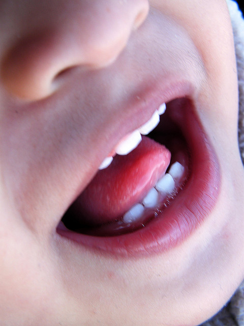 Study shows cavities have become the most common childhood disease - Scope