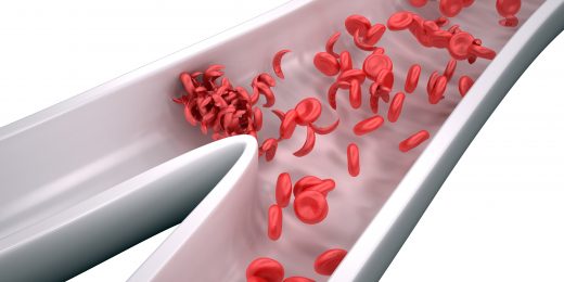 A step closer to gene therapy for sickle cell disease