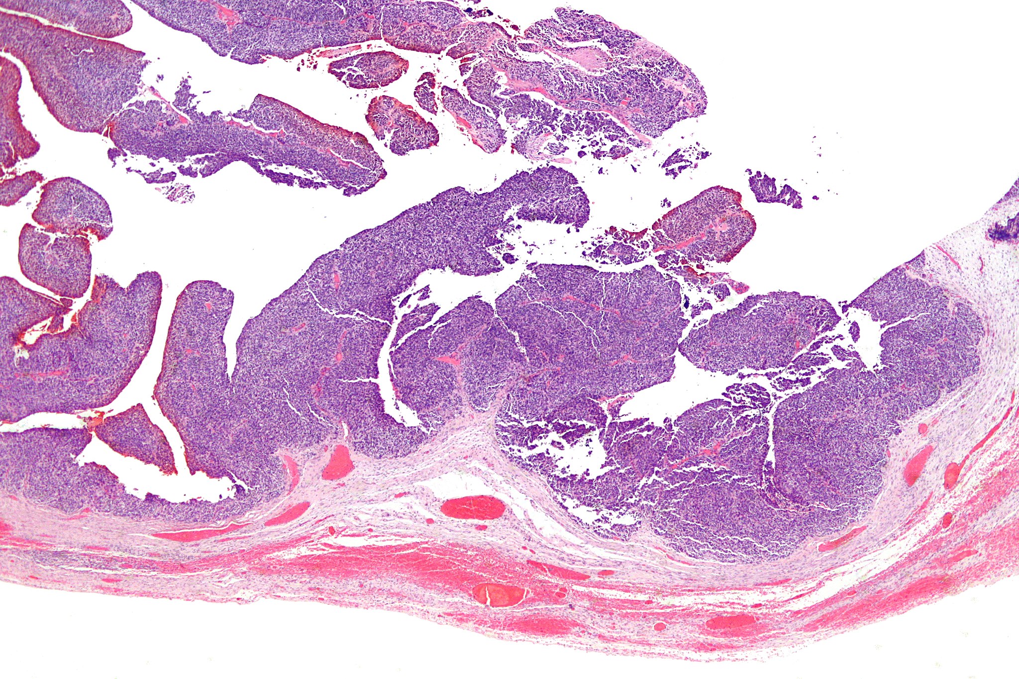 Slide image of ovarian cancer cells