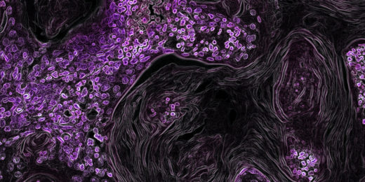 New imaging agent could help personalize lung cancer treatment