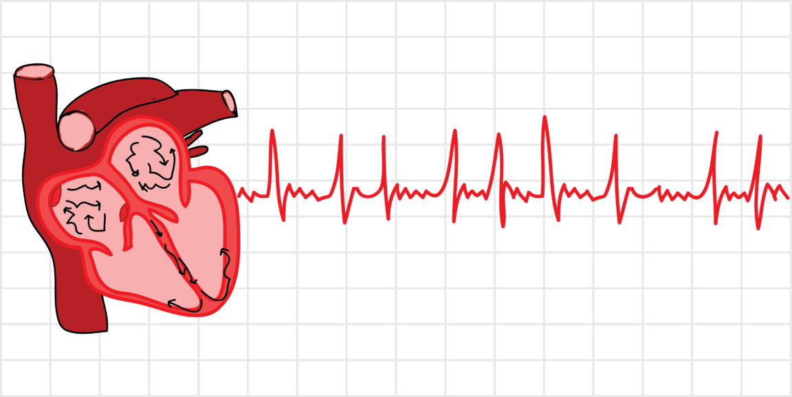 graphic showing atrial fibrillation