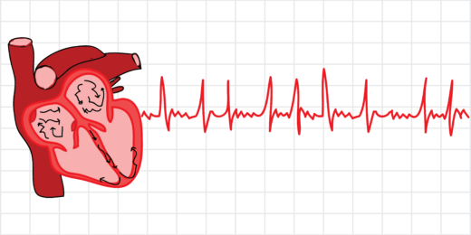 Understanding AFib: A heart dancing without rhythm