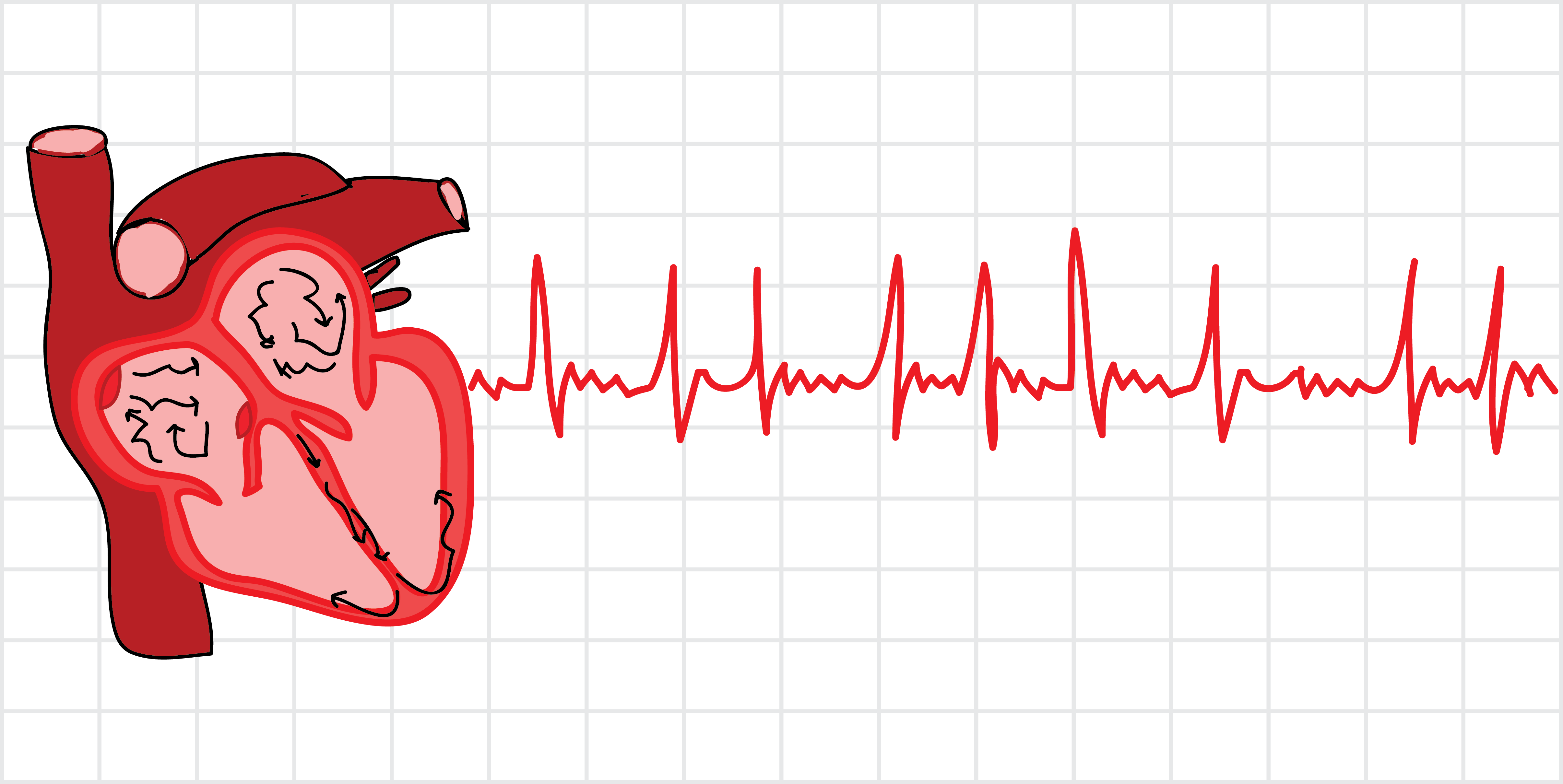 graphic showing atrial fibrillation