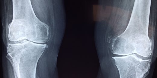 Preventing osteoarthritis, an orthopaedic surgeon’s goal