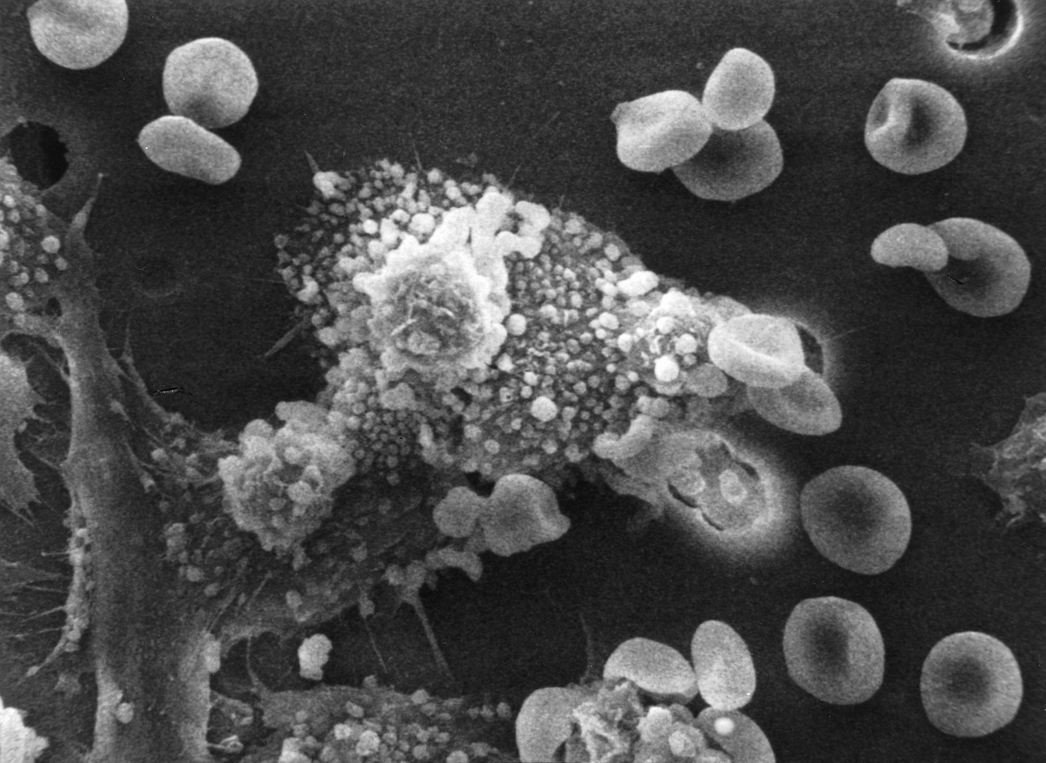 macrophages and cancer cells
