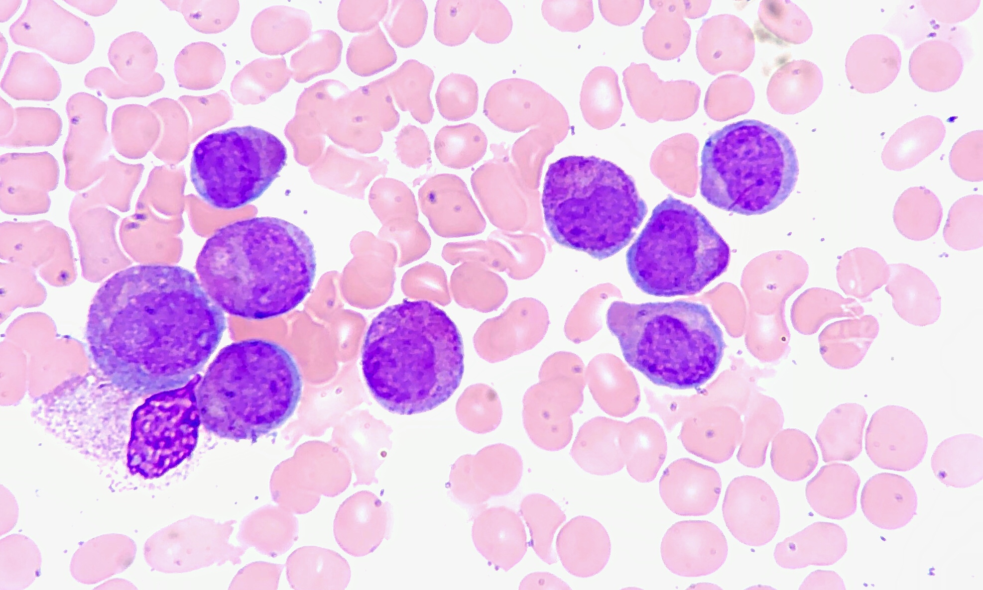 What Is Acute Myeloid Leukemia With Monocytic Differentiation