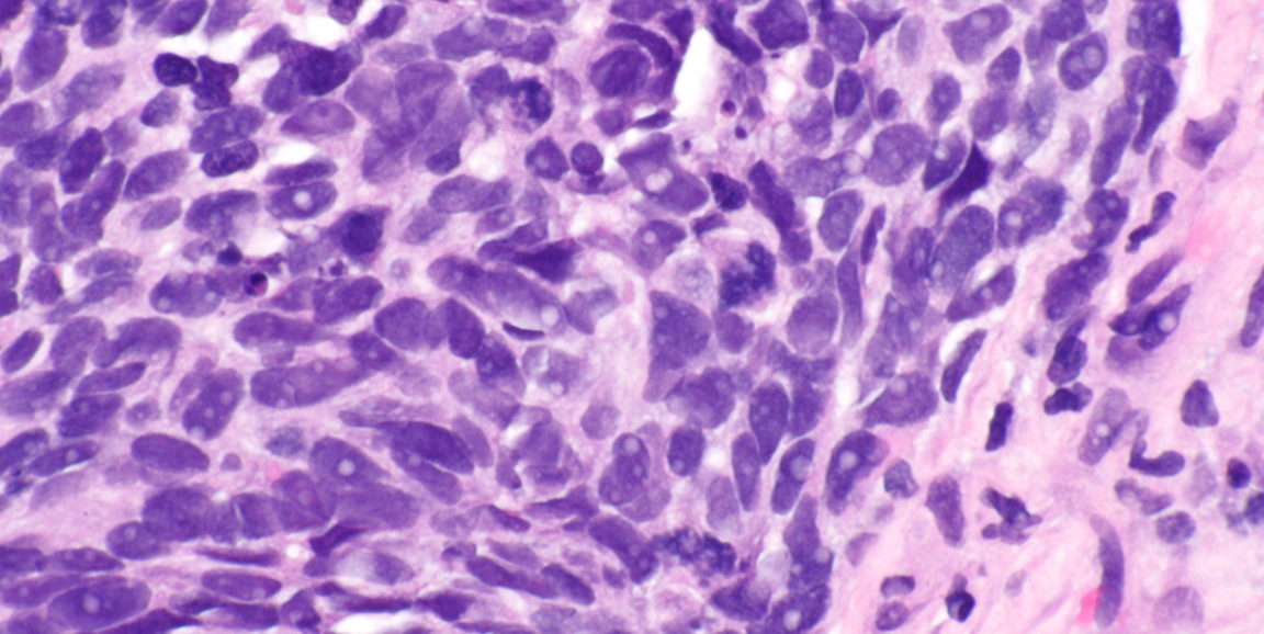 non-small cell lung carcinoma