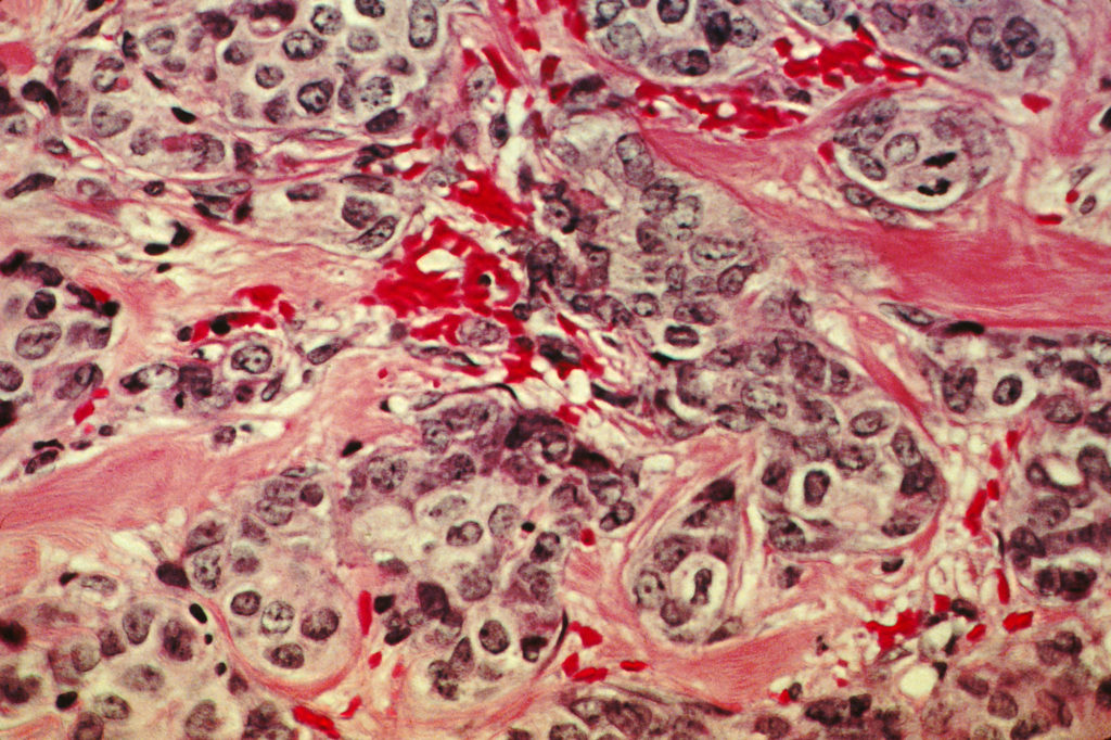 new-evidence-suggests-early-metastasis-is-common-in-lung-and-breast