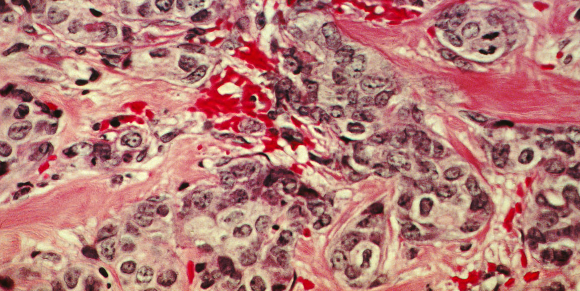 histological slide of cancerous breast tissue
