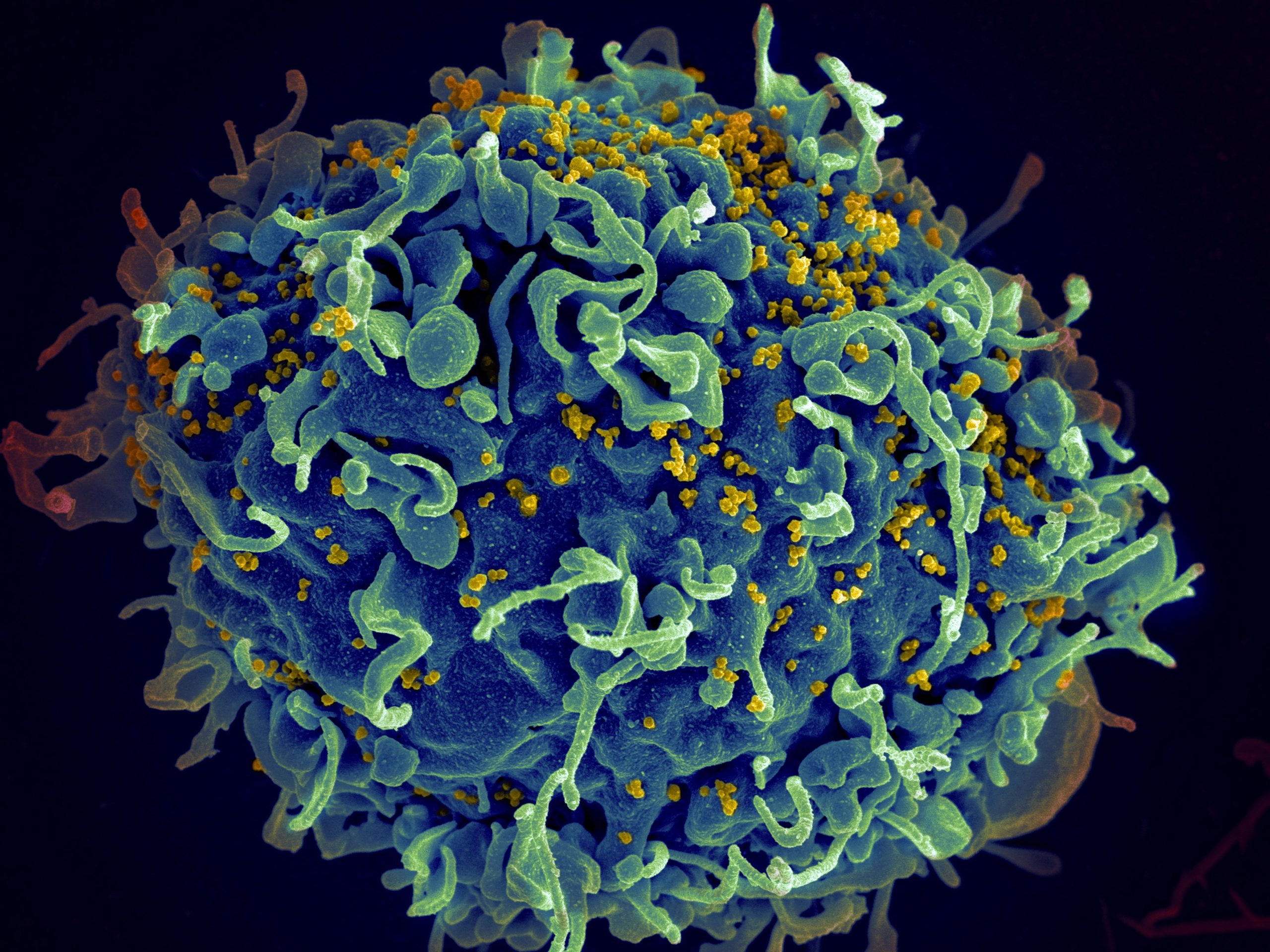 This human T cell is under attack by HIV, the virus that causes AIDS.