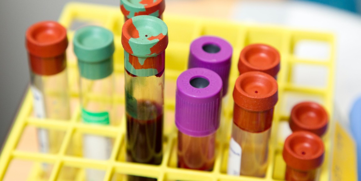 A test tube rack is filled with vials of blood.