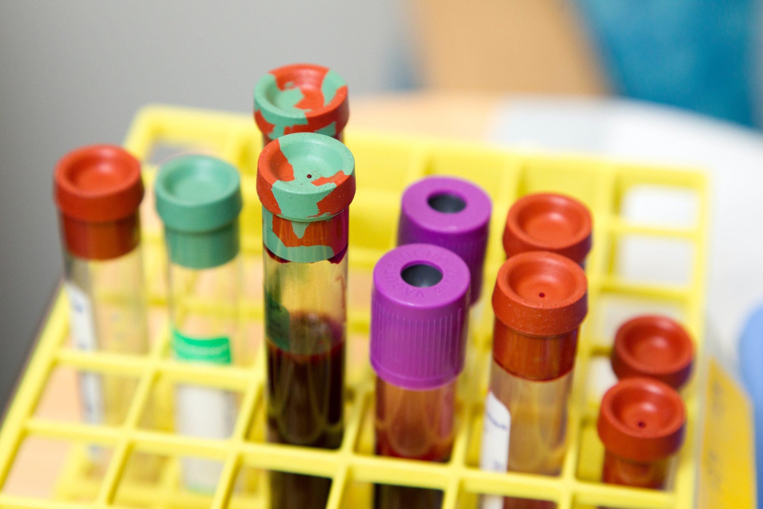 Blood test predicts chances of lymphoma relapse after therapy